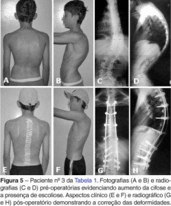 Correção Cirurgica Cifose Foto: Revista Brasileira de Ortopedia